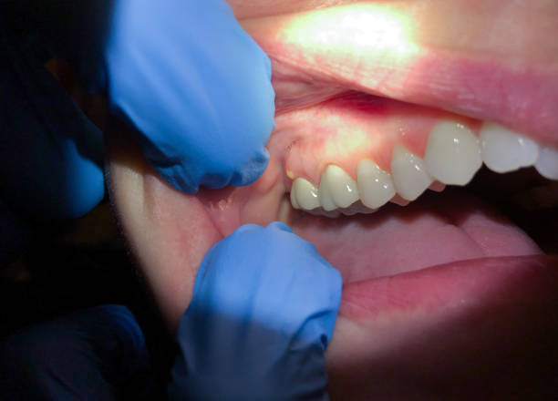 Best Emergency Treatment for Toothache in Chesapeake, VA
